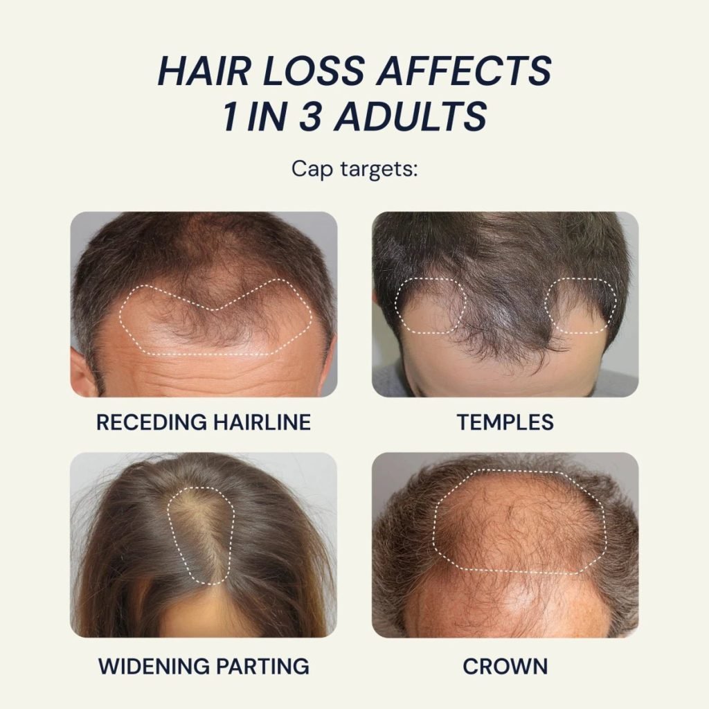 Hair Loss Treatment Areas Hairline Crown